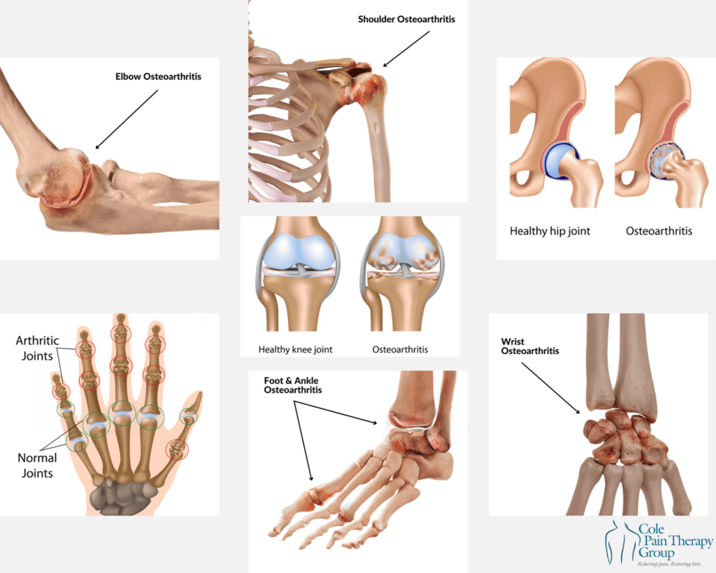 Osteoarthritis Treatment Fast Relief For Joint Pain And Quick Recovery 