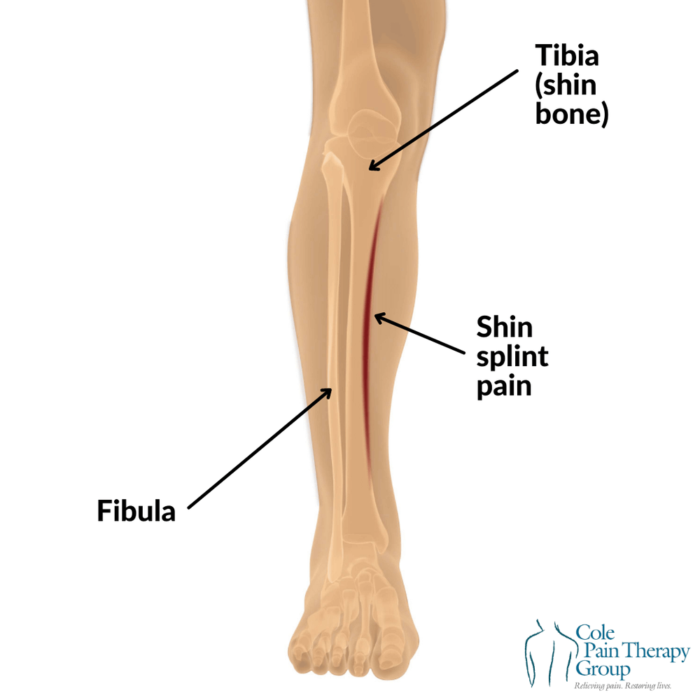 Overcoming MTSS How To Treat Shin Splints And Improve Your Recovery 