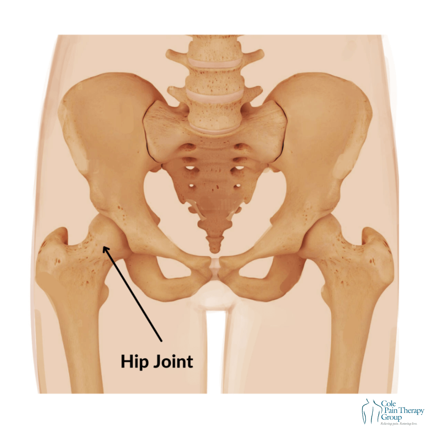 Hip Dysfunction Understanding and Treating Hip Pain: A Complete Recovery Guide - Cole ...