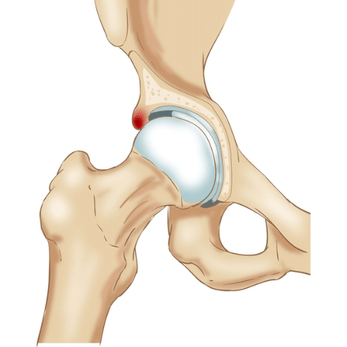 An anatomical illustration of femoroacetabular impingement (FAI) showing abnormal contact between the femur and hip socket.