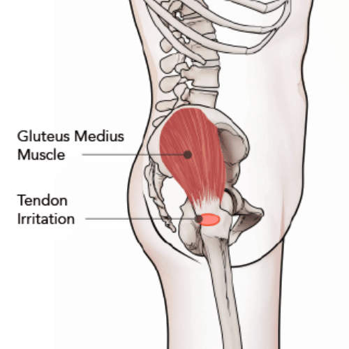 Anatomical illustration showing gluteus medius muscle and irritated tendon on the outer hip.