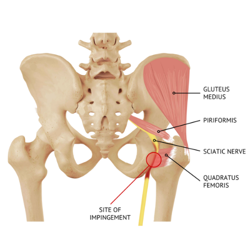 Illustration of skeletal alignment showing weak hip abductors and knee valgus posture.