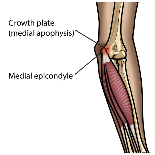 Diagram of the elbow highlighting growth plate stress and medial epicondyle in Little League Elbow.