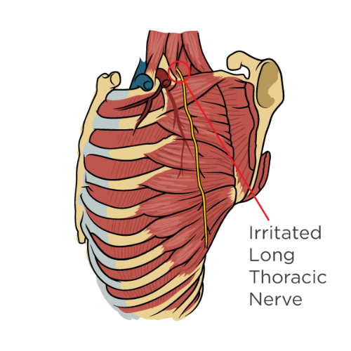Anatomy illustration of the upper back highlighting an irritated long thoracic nerve.