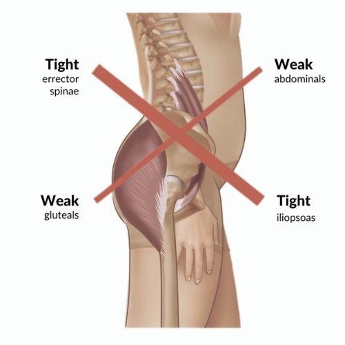 Diagram of lower crossed syndrome illustrating tight and weak muscle groups in the lower back and hip area.