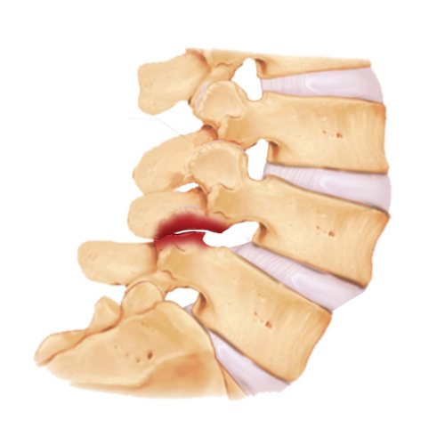Diagram showing Type II Isthmic Lumbar Spondylolisthesis with vertebral slippage at the pars interarticularis.
