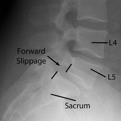 X-ray of lumbar spine showing degenerative spondylolisthesis with L5 vertebra slipping forward on the sacrum.