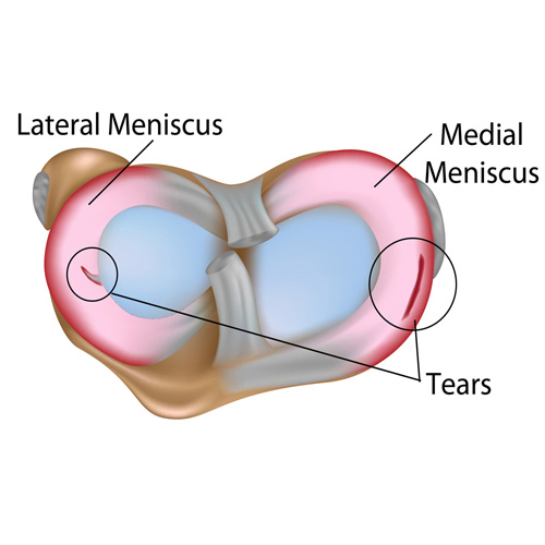 Diagram of the knee joint showing medial and lateral meniscus with labeled tear areas.