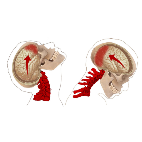 Diagram showing brain movement in mild traumatic brain injury (mTBI) due to whiplash forces on the cervical spine.
