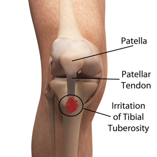 Anatomical image of the knee showing patella, patellar tendon, and irritation at the tibial tuberosity indicating Osgood-Schlatter disease.