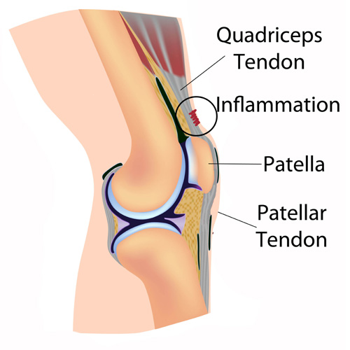Medical illustration showing patellar and quadriceps tendinopathy with inflammation above the kneecap
