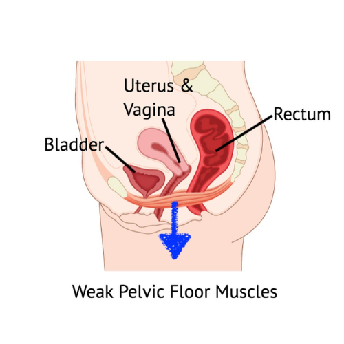 Cross-section diagram of female pelvic anatomy showing weakened pelvic floor muscles.