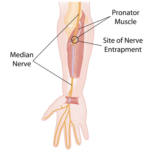 Anatomical diagram showing median nerve entrapment at the pronator muscle in the forearm.