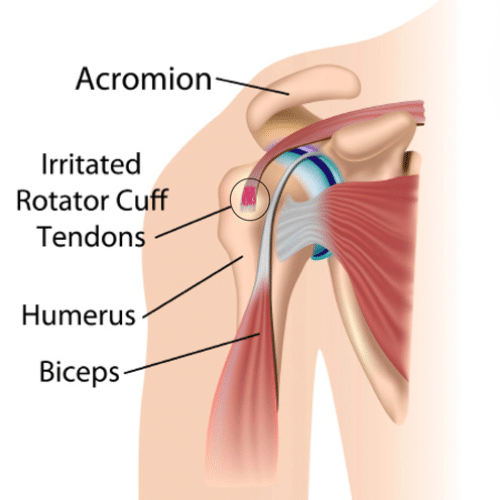 Medical illustration of shoulder anatomy highlighting irritated rotator cuff tendons beneath the acromion.