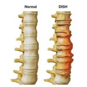 Diffuse Idiopathic Skeletal Hyperostosis (DISH) Treatment Options
