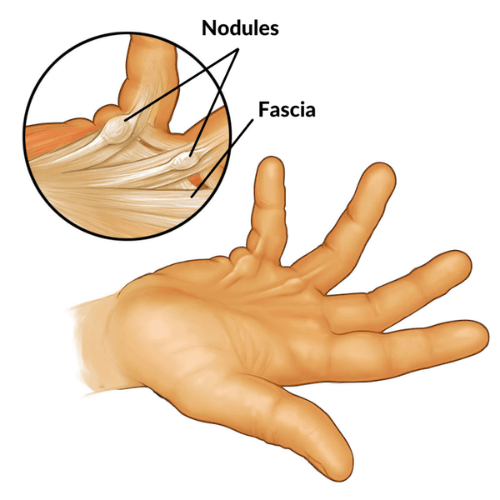 Anatomical illustration of a hand with Dupuytren’s contracture showing thickened fascia and nodules.