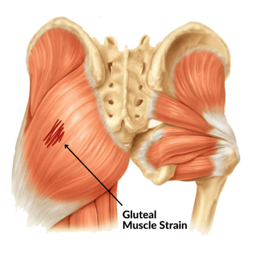 Anatomical illustration of the pelvis and upper leg showing a gluteal muscle strain on the left side.