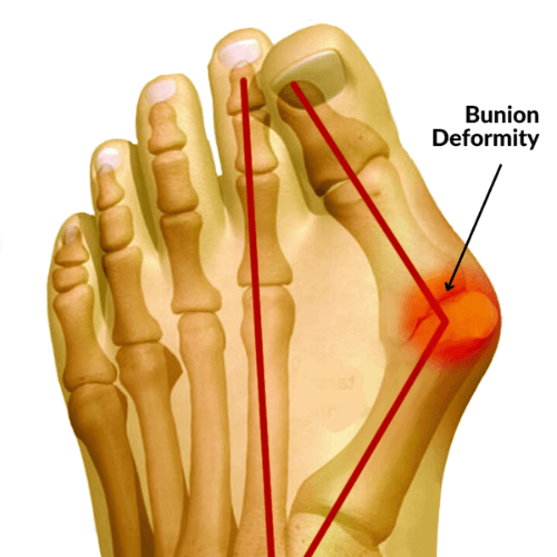Anatomical illustration of a foot showing bunion deformity (hallux valgus) at the base of the big toe.