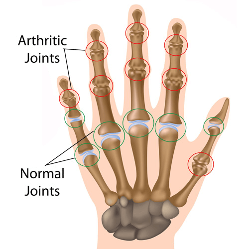 Anatomical illustration of a hand showing arthritic joints (highlighted in red) compared to normal joints (highlighted in blue/green).