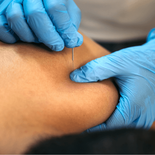 Close-up of a practitioner performing dry needling on a patient's shoulder while wearing blue medical gloves.
