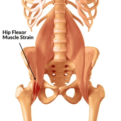 Illustration of a hip flexor muscle strain affecting the iliopsoas group, showing pain in the front of the hip.