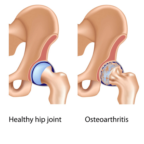Comparison of a healthy hip joint and one affected by osteoarthritis.