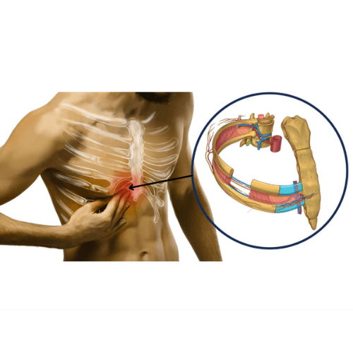 Illustration of intercostal neuralgia showing pain location and affected nerves between the ribs.