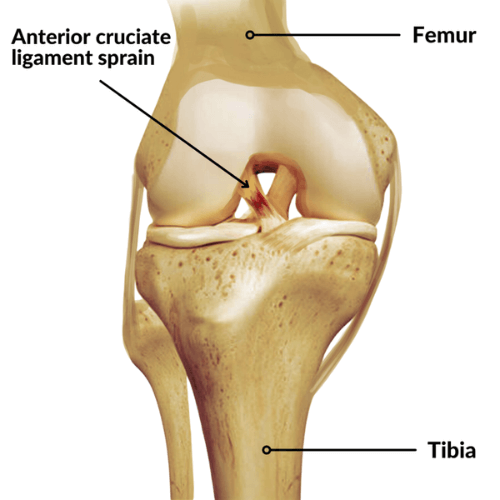 Illustration of an anterior cruciate ligament (ACL) sprain in the knee joint showing the femur, tibia, and the injured ACL between them.