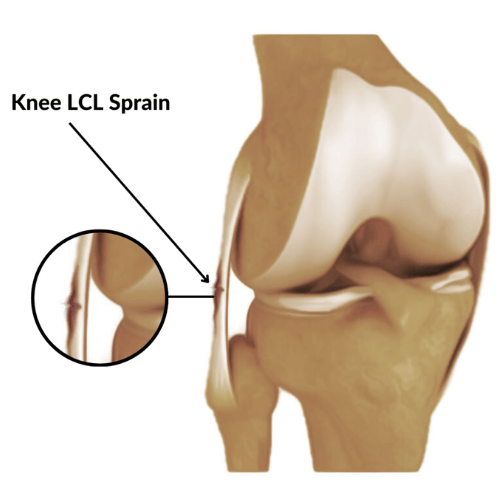 Medical illustration of a Knee LCL (Lateral Collateral Ligament) sprain, showing the ligament location and injury site on the outer side of the knee.
