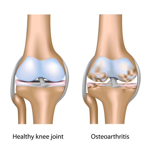 Side-by-side comparison of a healthy knee joint and a knee with osteoarthritis showing cartilage damage and joint space narrowing.