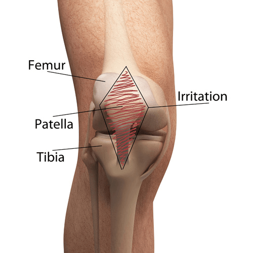 Illustration of patellofemoral pain syndrome showing irritation in the front of the knee between the femur and patella.