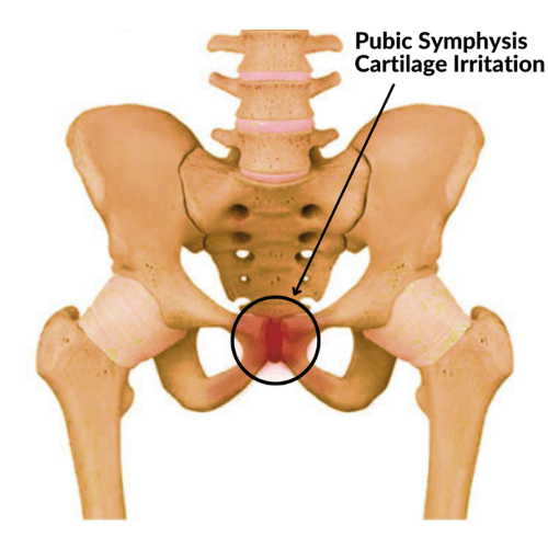 Anatomical illustration highlighting pubic symphysis cartilage irritation in the pelvis.