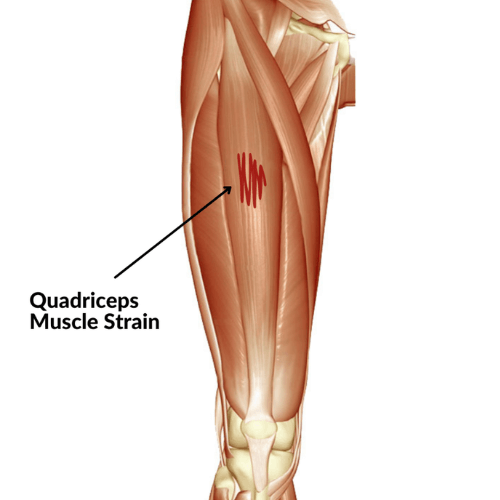 Illustration of a quadriceps muscle strain showing muscle fibers and highlighted injury location.