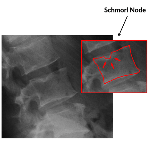 X-ray of a lumbar spine with Schmorl’s node highlighted on a vertebral body endplate.