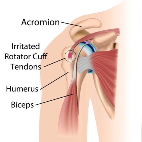 Diagram showing anterior shoulder impingement with irritated rotator cuff tendons compressed under the acromion.