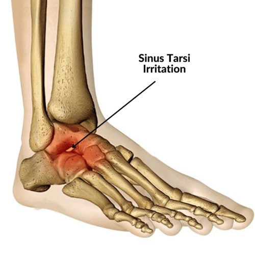 Medical illustration showing an inflamed region of the foot labeled “Sinus Tarsi Irritation.”
