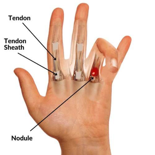 Hand showing anatomical structures involved in stenosing tenosynovitis, including tendon, tendon sheath, and a red nodule at the base of the finger.