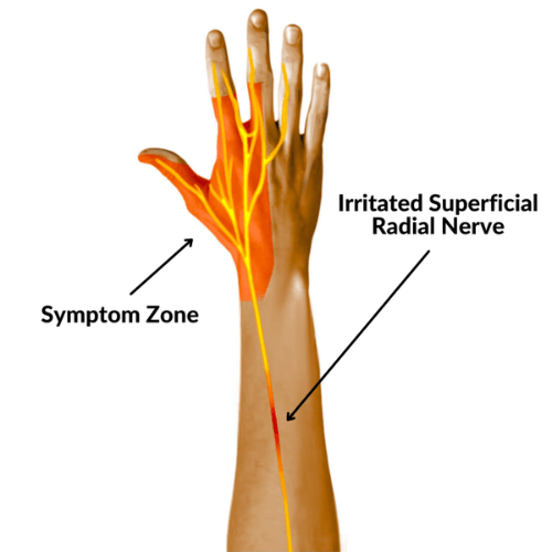 Illustration of superficial radial neuropathy showing irritated superficial radial nerve and symptom zone in the hand and forearm