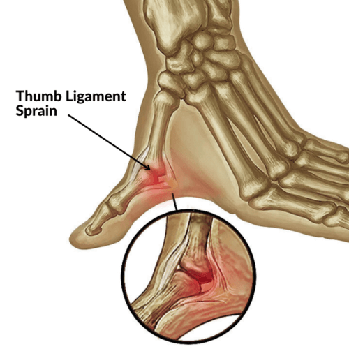 Illustration of a thumb ligament sprain showing ligament damage at the base of the thumb with highlighted inflammation.