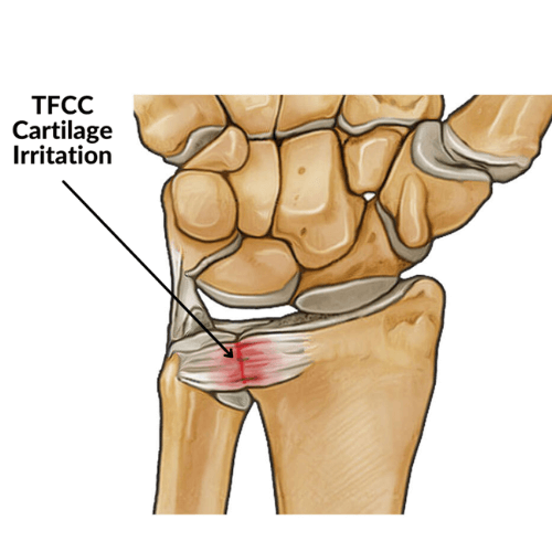 Illustration of TFCC cartilage irritation in the wrist, highlighting the triangular fibrocartilage complex.