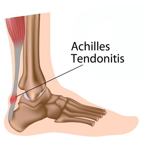 An anatomical illustration showing Achilles tendon inflammation at the back of the ankle.
