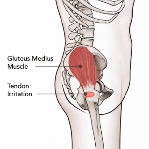 Illustration of gluteus medius tendon irritation at the outer hip.