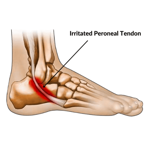 Illustration of peroneal tendon irritation along the outer ankle and foot.