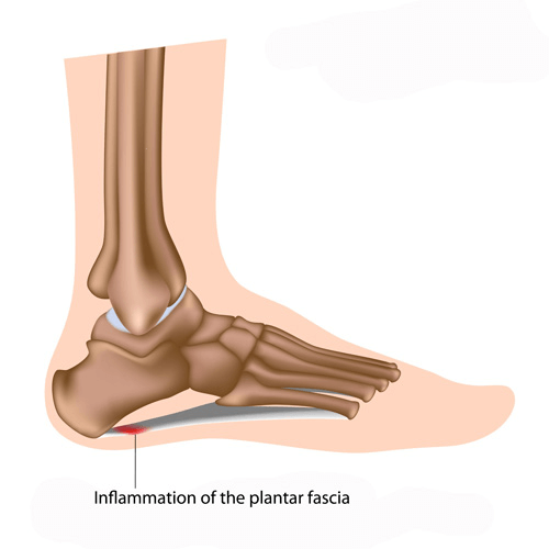 Medical illustration of plantar fasciitis showing inflammation of the plantar fascia at the heel of the foot.