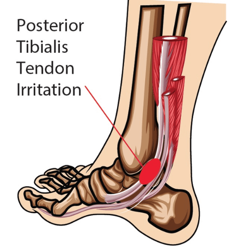 Illustration of posterior tibial tendon irritation along the inner ankle and arch of the foot.