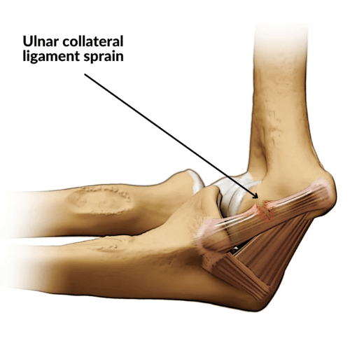 Illustration of an elbow with a labeled ulnar collateral ligament sprain showing ligament damage on the inner side of the elbow.