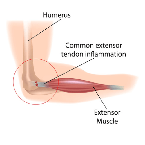 Illustration of elbow tendonitis showing inflammation of the common extensor tendon at the lateral epicondyle of the humerus.