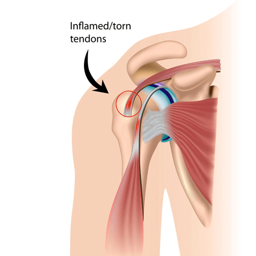Illustration of a human shoulder showing inflammation or tearing of the rotator cuff tendons.