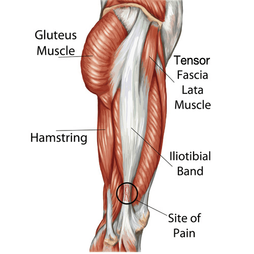 Illustration showing iliotibial band syndrome with irritation on the outer knee where the IT band crosses the joint.