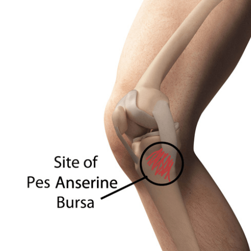 Illustration showing pes anserine bursitis with inflammation on the inner side of the knee.